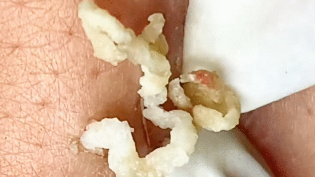 Banish Blackheads The Ultimate Guide to Clear Skin Acne Treatment